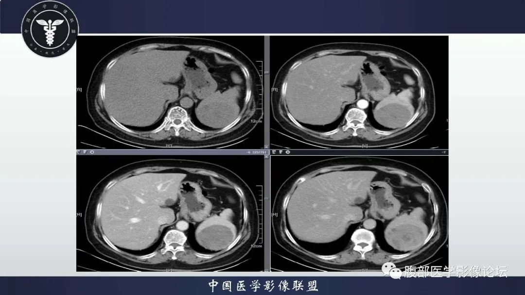 影像PPT - 【病例】脾脏窦岸细胞血管瘤1例CT影像-7 影像PPT - 【病例】脾脏窦岸细胞血管瘤1例CT影像-7