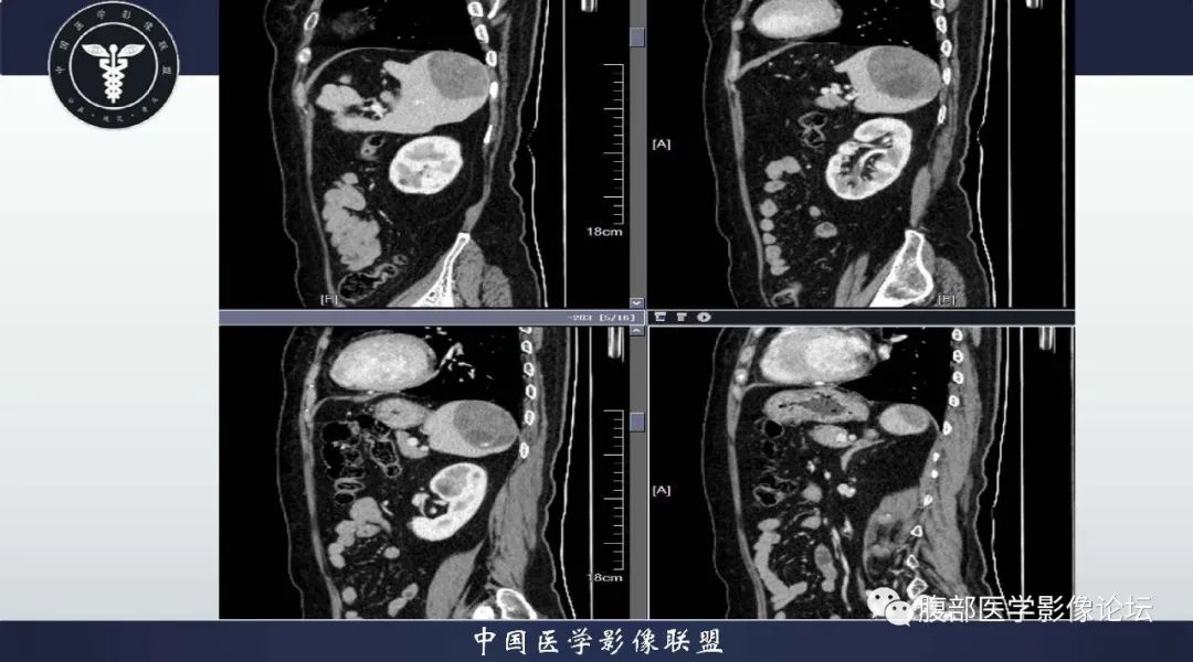 影像PPT - 【病例】脾脏窦岸细胞血管瘤1例CT影像-11 影像PPT - 【病例】脾脏窦岸细胞血管瘤1例CT影像-11