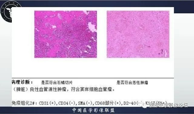 影像PPT - 【病例】脾脏窦岸细胞血管瘤1例CT影像-12 影像PPT - 【病例】脾脏窦岸细胞血管瘤1例CT影像-12