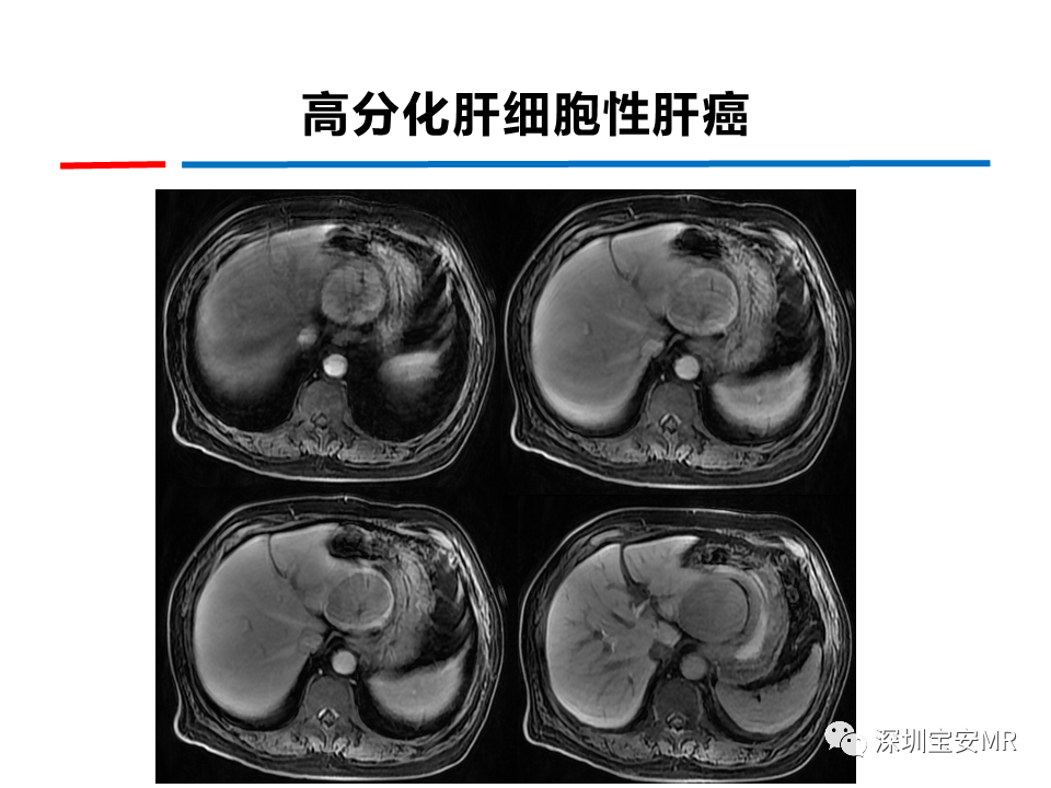 影像PPT - 【PPT】GD-EOB-DTPA肝胆期高信号的病变-11