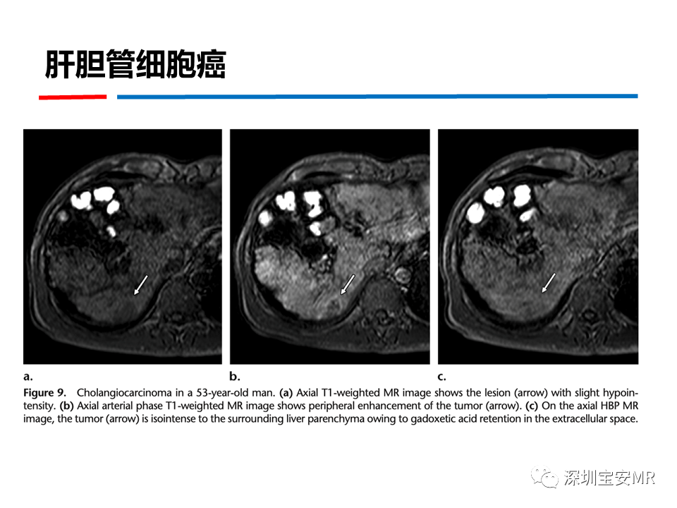 影像PPT - 【PPT】GD-EOB-DTPA肝胆期高信号的病变-28