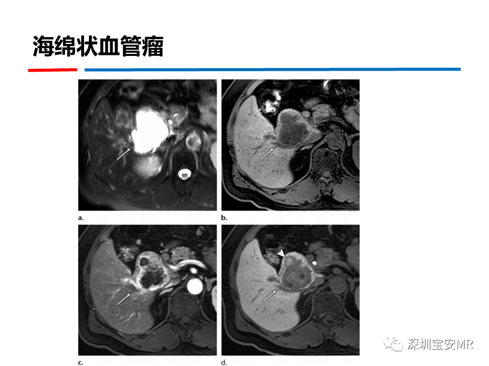 影像PPT - 【PPT】GD-EOB-DTPA肝胆期高信号的病变-30