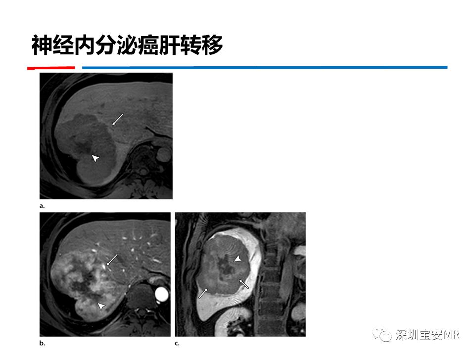 影像PPT - 【PPT】GD-EOB-DTPA肝胆期高信号的病变-29