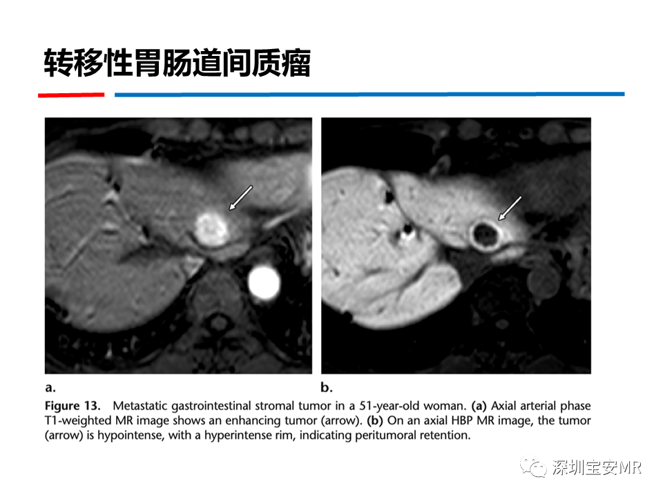 影像PPT - 【PPT】GD-EOB-DTPA肝胆期高信号的病变-34
