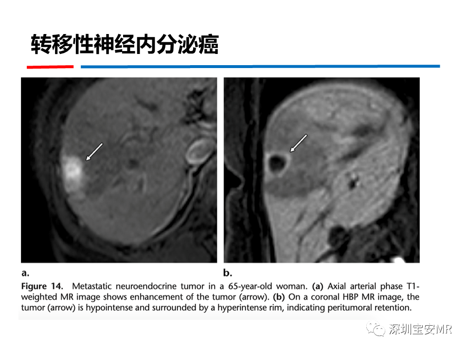 影像PPT - 【PPT】GD-EOB-DTPA肝胆期高信号的病变-35