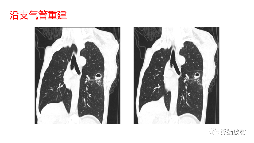 影像PPT - 【病例】肺空洞性病变—肺炎性病变 VS 黏液腺癌-10