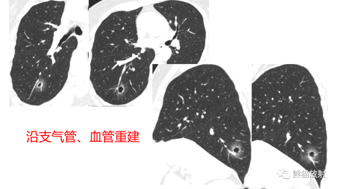 影像PPT - 【病例】肺空洞性病变—肺炎性病变 VS 黏液腺癌-18