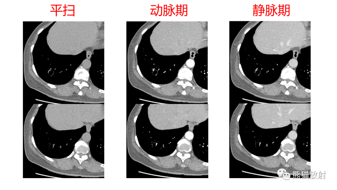 影像PPT - 【病例】肺空洞性病变—肺炎性病变 VS 黏液腺癌-16