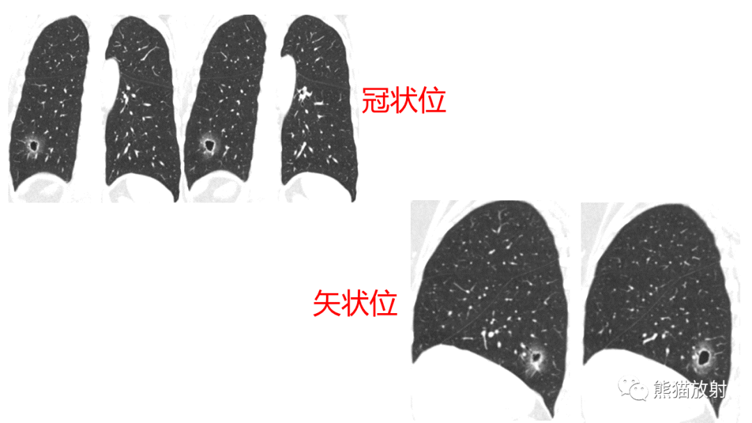 影像PPT - 【病例】肺空洞性病变—肺炎性病变 VS 黏液腺癌-17