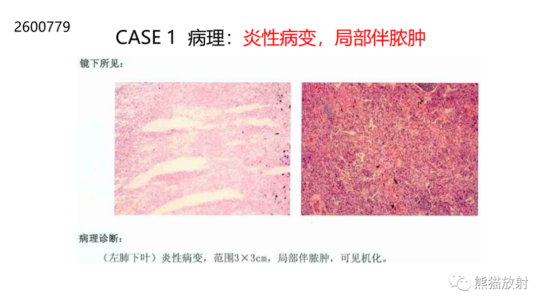 影像PPT - 【病例】肺空洞性病变—肺炎性病变 VS 黏液腺癌-21