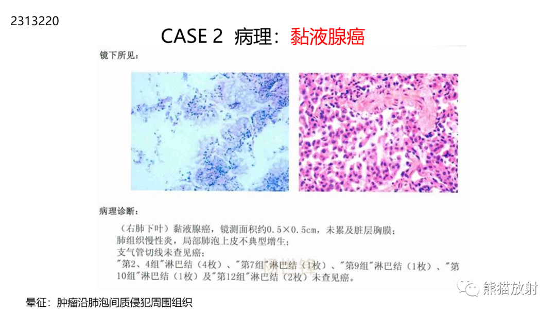 影像PPT - 【病例】肺空洞性病变—肺炎性病变 VS 黏液腺癌-22