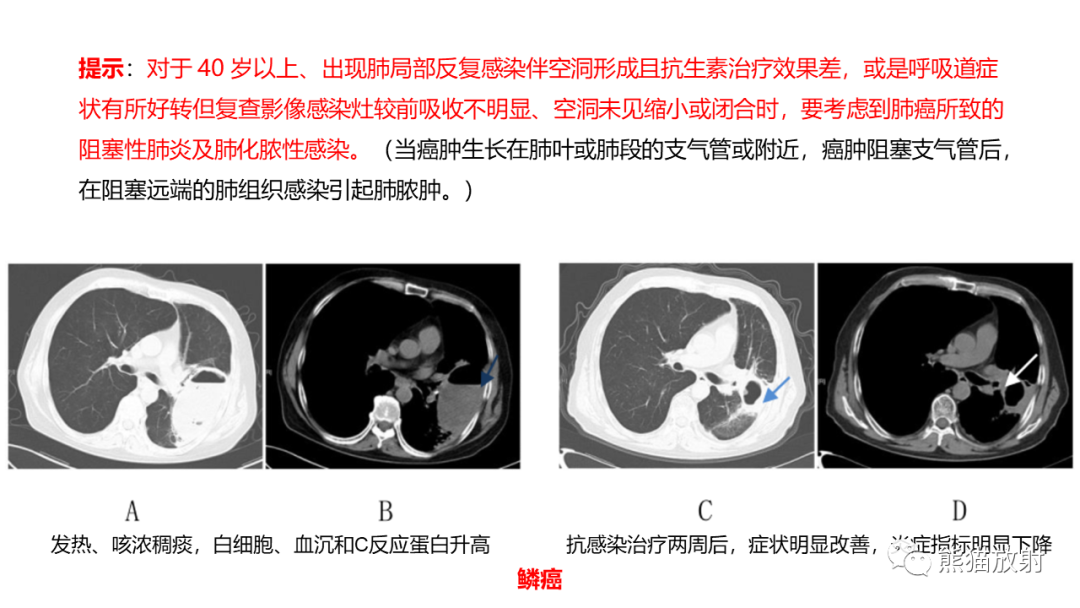影像PPT - 【病例】肺空洞性病变—肺炎性病变 VS 黏液腺癌-26