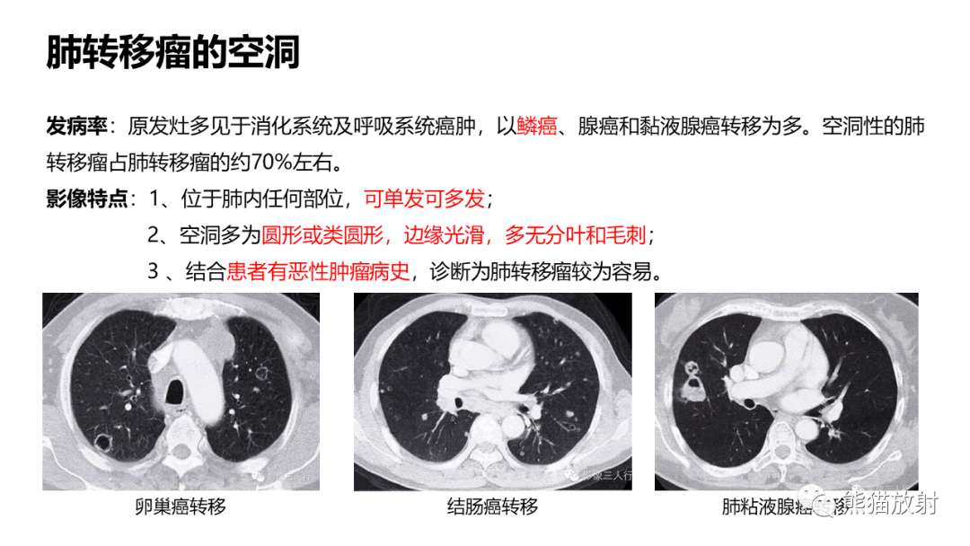 影像PPT - 【病例】肺空洞性病变—肺炎性病变 VS 黏液腺癌-27