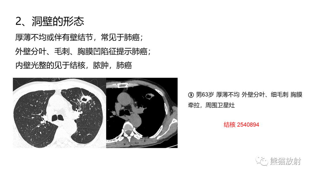 影像PPT - 【病例】肺空洞性病变—肺炎性病变 VS 黏液腺癌-34