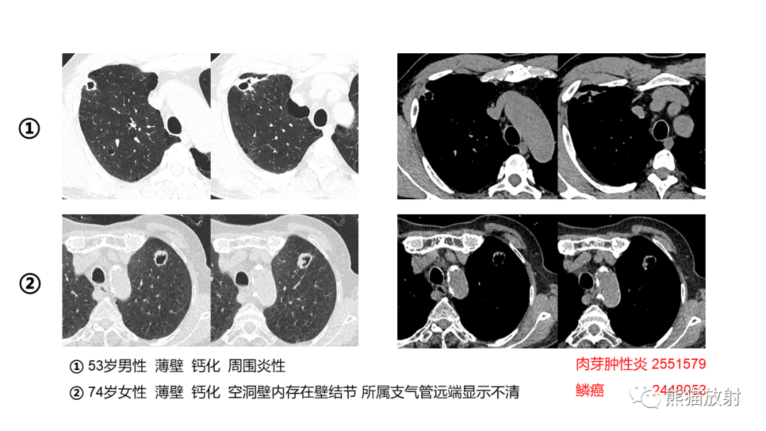 影像PPT - 【病例】肺空洞性病变—肺炎性病变 VS 黏液腺癌-33