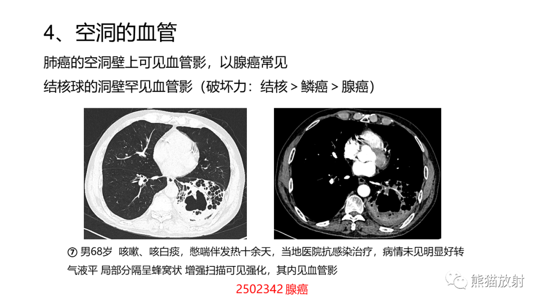 影像PPT - 【病例】肺空洞性病变—肺炎性病变 VS 黏液腺癌-36