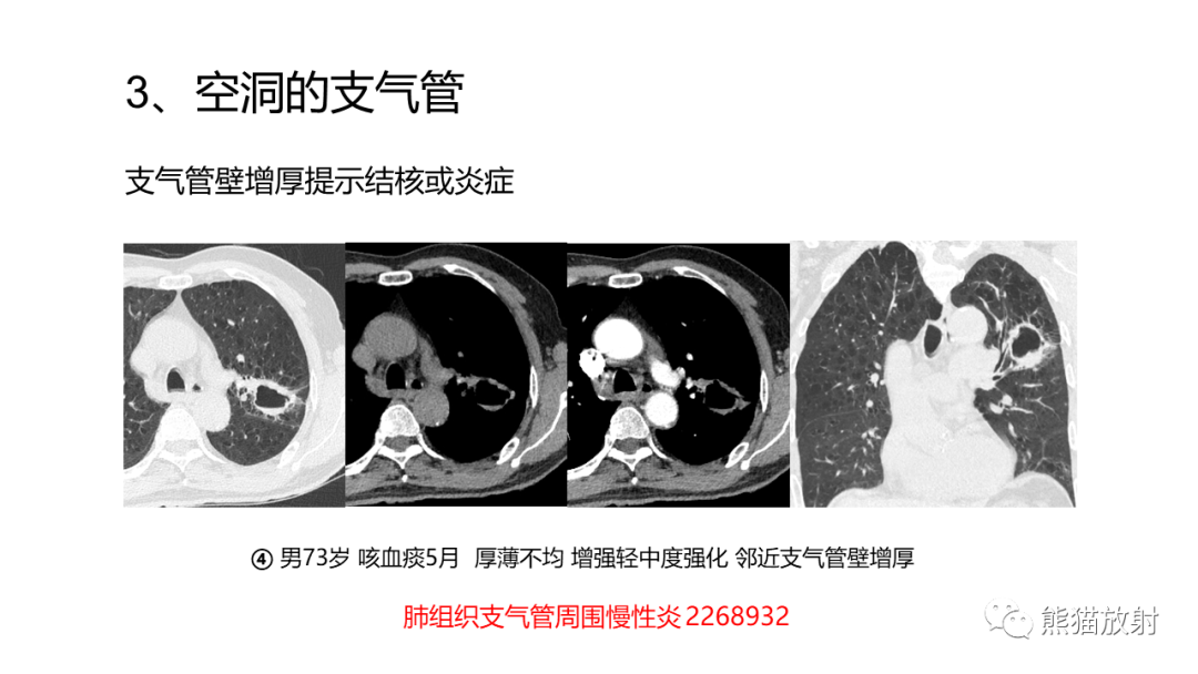 影像PPT - 【病例】肺空洞性病变—肺炎性病变 VS 黏液腺癌-35
