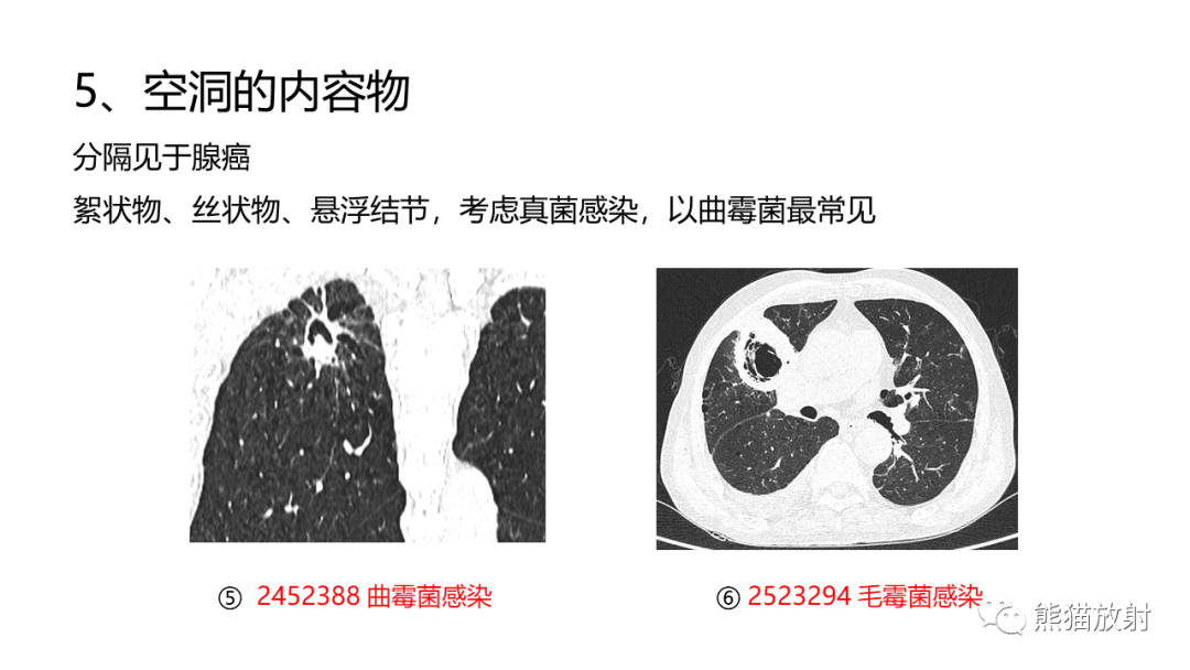 影像PPT - 【病例】肺空洞性病变—肺炎性病变 VS 黏液腺癌-37
