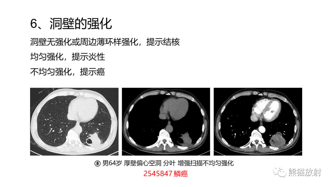 影像PPT - 【病例】肺空洞性病变—肺炎性病变 VS 黏液腺癌-38