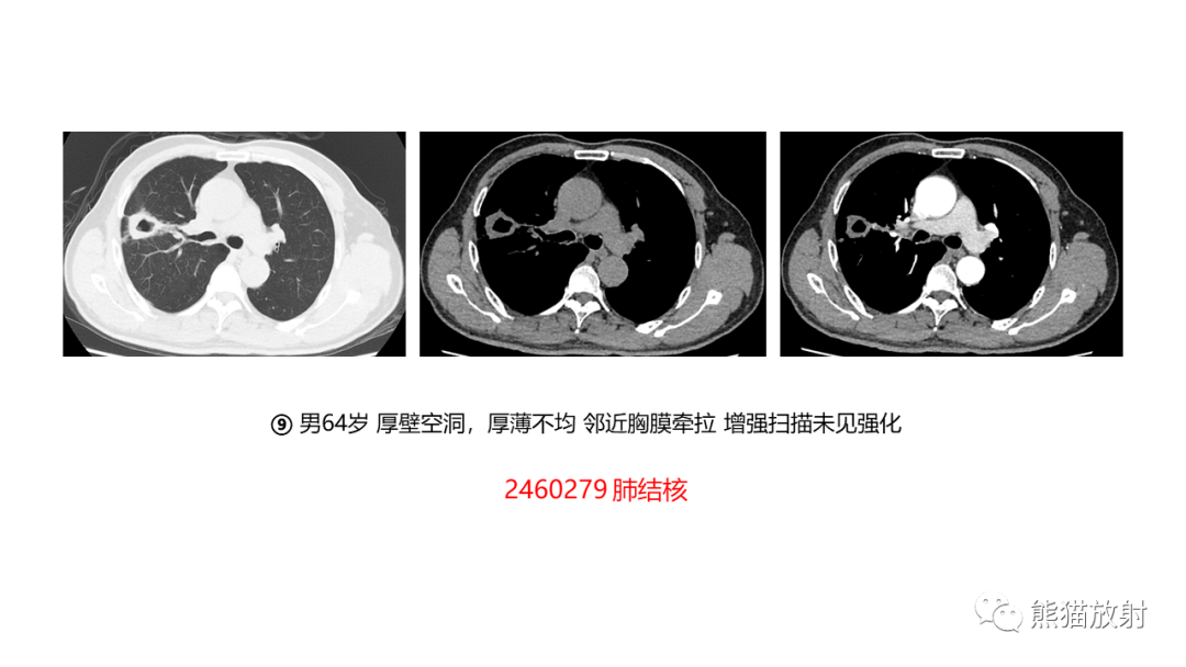 影像PPT - 【病例】肺空洞性病变—肺炎性病变 VS 黏液腺癌-39