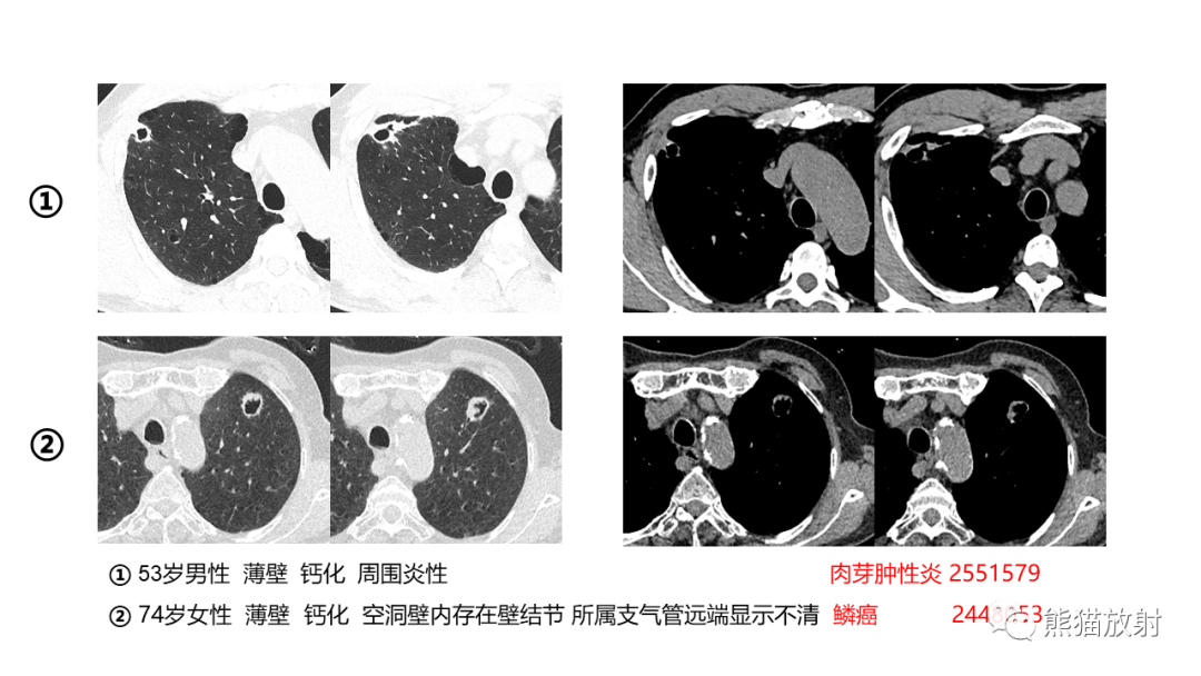 影像PPT - 【病例】肺空洞性病变—肺炎性病变 VS 黏液腺癌-41