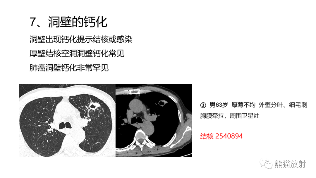 影像PPT - 【病例】肺空洞性病变—肺炎性病变 VS 黏液腺癌-40