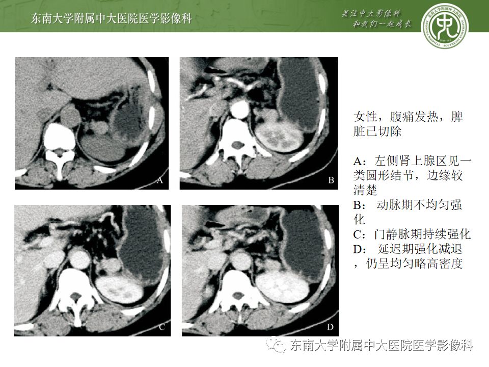 影像PPT - 【PPT】脾脏先天性异常-12