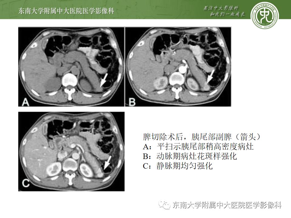 影像PPT - 【PPT】脾脏先天性异常-11