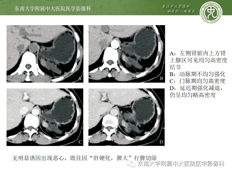 影像PPT - 【PPT】脾脏先天性异常-13