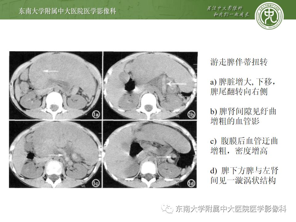 影像PPT - 【PPT】脾脏先天性异常-15