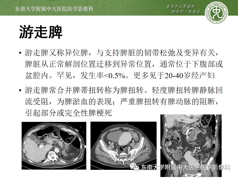 影像PPT - 【PPT】脾脏先天性异常-14