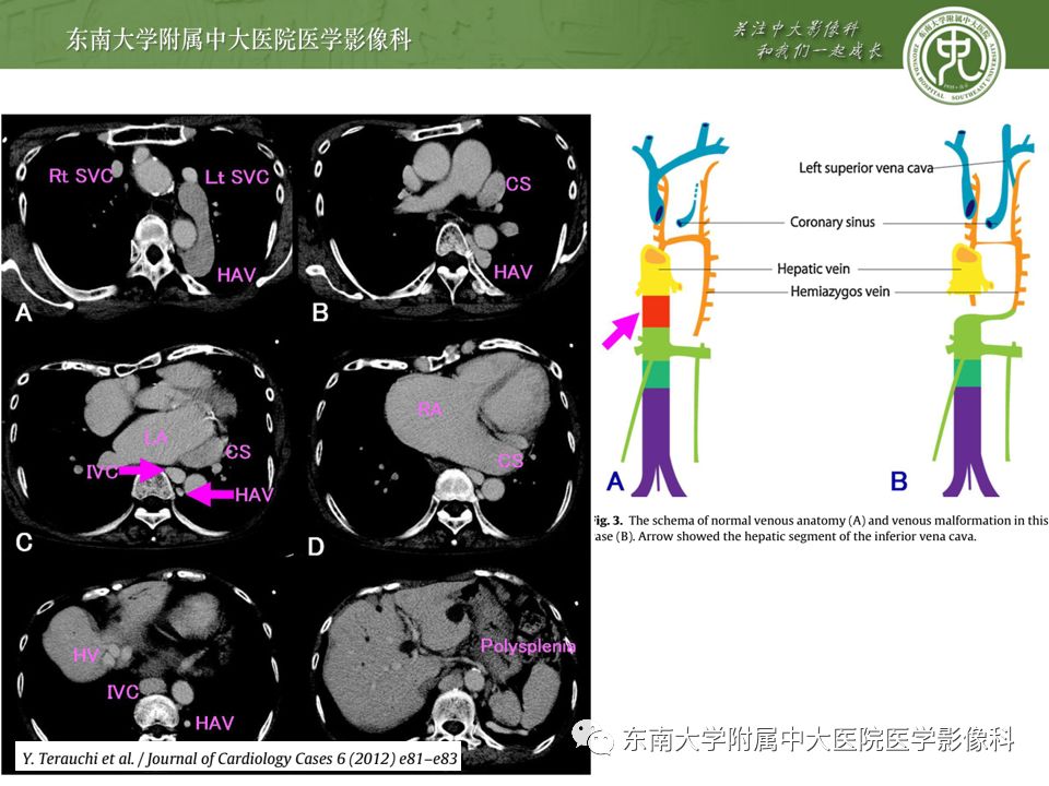影像PPT - 【PPT】脾脏先天性异常-21