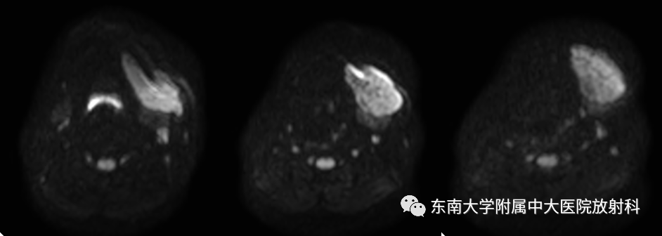 影像PPT - 【PPT】颌下间隙病变影像诊断-7 影像PPT - 【PPT】颌下间隙病变影像诊断-7