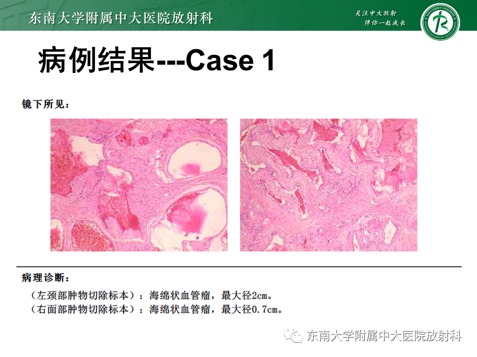 影像PPT - 【PPT】颌下间隙病变影像诊断-16 影像PPT - 【PPT】颌下间隙病变影像诊断-16