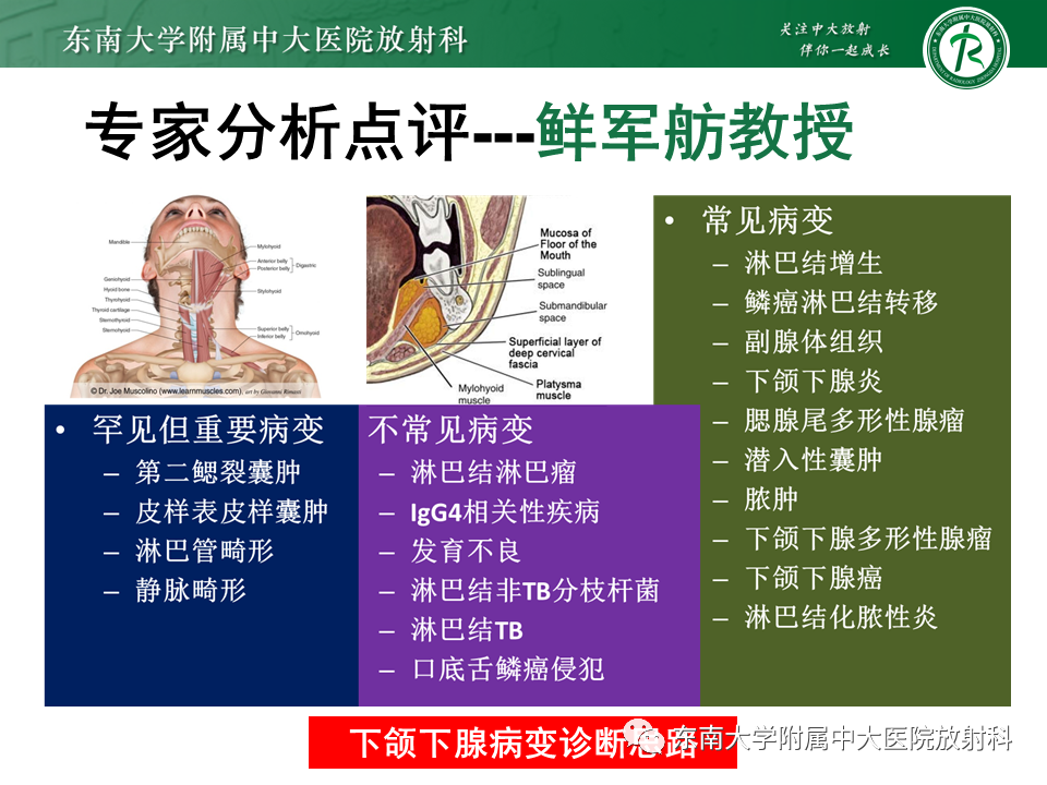 影像PPT - 【PPT】颌下间隙病变影像诊断-20 影像PPT - 【PPT】颌下间隙病变影像诊断-20