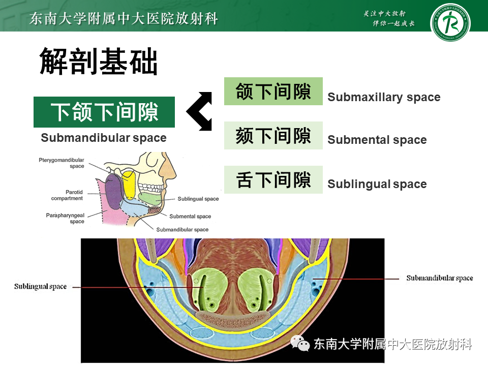 影像PPT - 【PPT】颌下间隙病变影像诊断-24 影像PPT - 【PPT】颌下间隙病变影像诊断-24