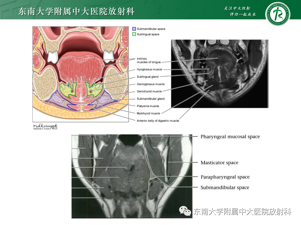 影像PPT - 【PPT】颌下间隙病变影像诊断-28 影像PPT - 【PPT】颌下间隙病变影像诊断-28