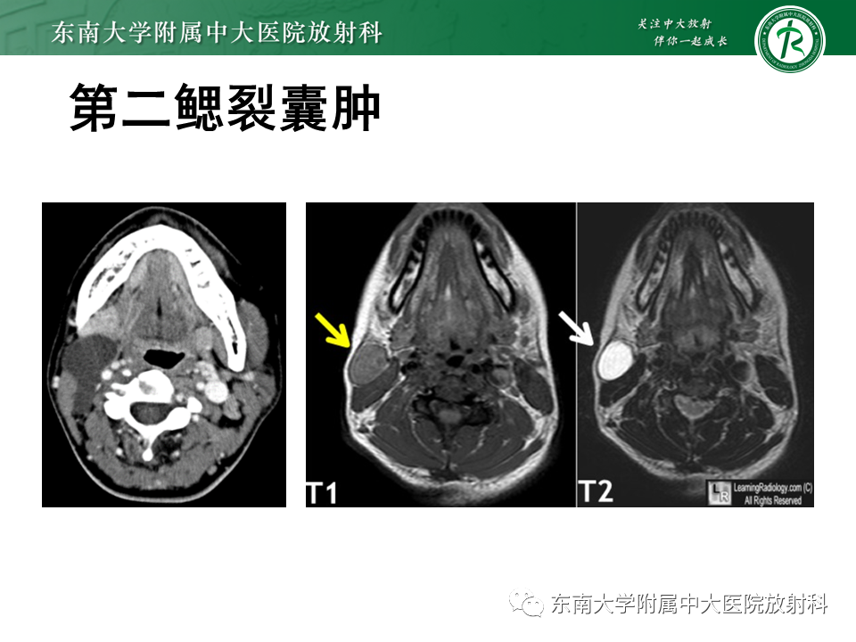 影像PPT - 【PPT】颌下间隙病变影像诊断-31 影像PPT - 【PPT】颌下间隙病变影像诊断-31