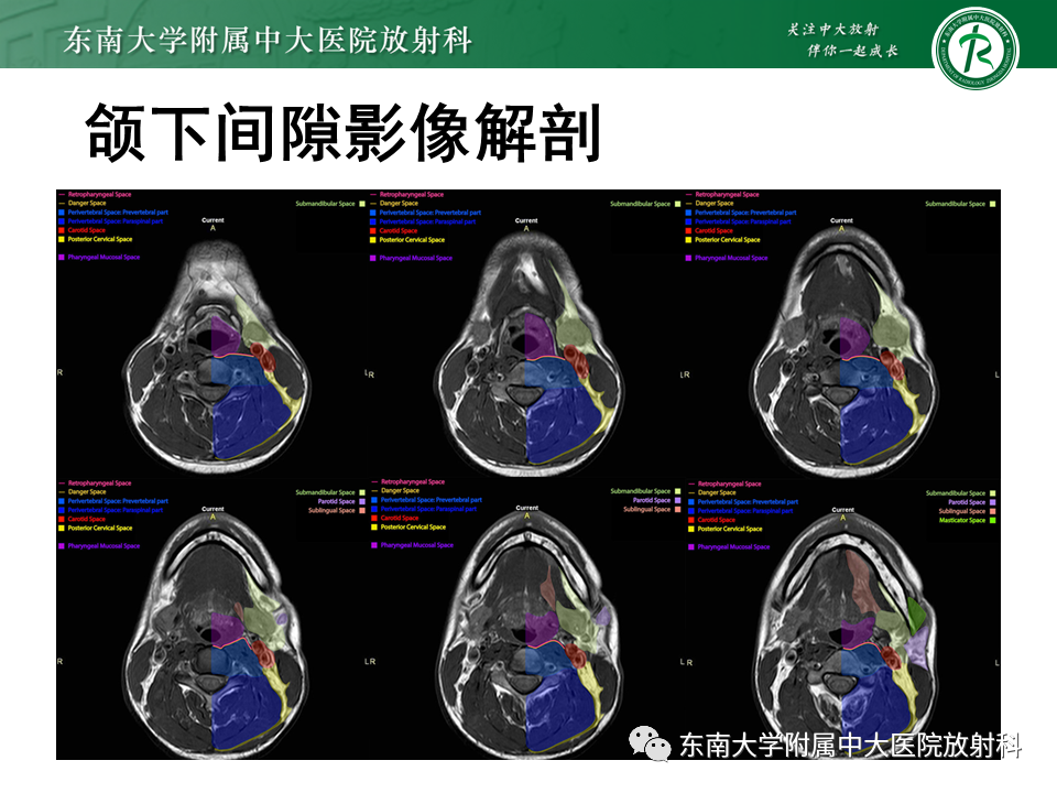 影像PPT - 【PPT】颌下间隙病变影像诊断-27 影像PPT - 【PPT】颌下间隙病变影像诊断-27