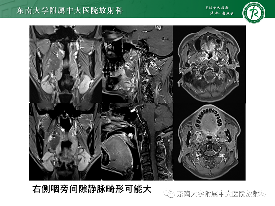 影像PPT - 【PPT】颌下间隙病变影像诊断-37 影像PPT - 【PPT】颌下间隙病变影像诊断-37