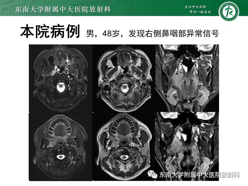 影像PPT - 【PPT】颌下间隙病变影像诊断-36 影像PPT - 【PPT】颌下间隙病变影像诊断-36