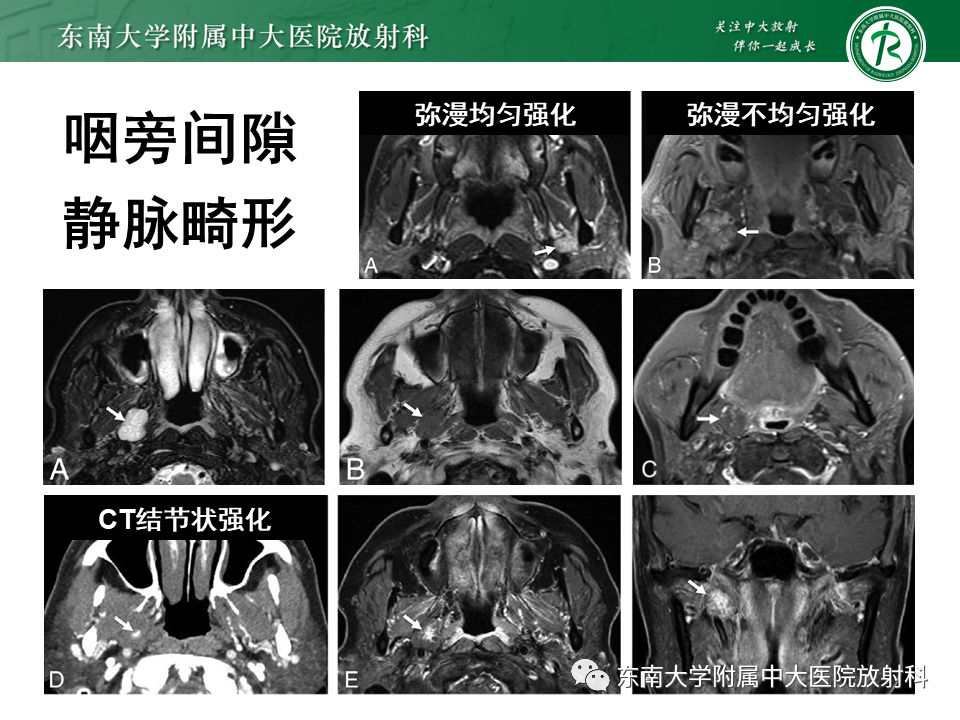 影像PPT - 【PPT】颌下间隙病变影像诊断-35 影像PPT - 【PPT】颌下间隙病变影像诊断-35
