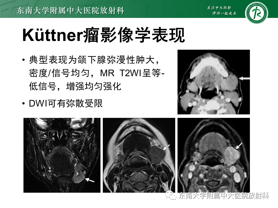 影像PPT - 【PPT】颌下间隙病变影像诊断-46 影像PPT - 【PPT】颌下间隙病变影像诊断-46
