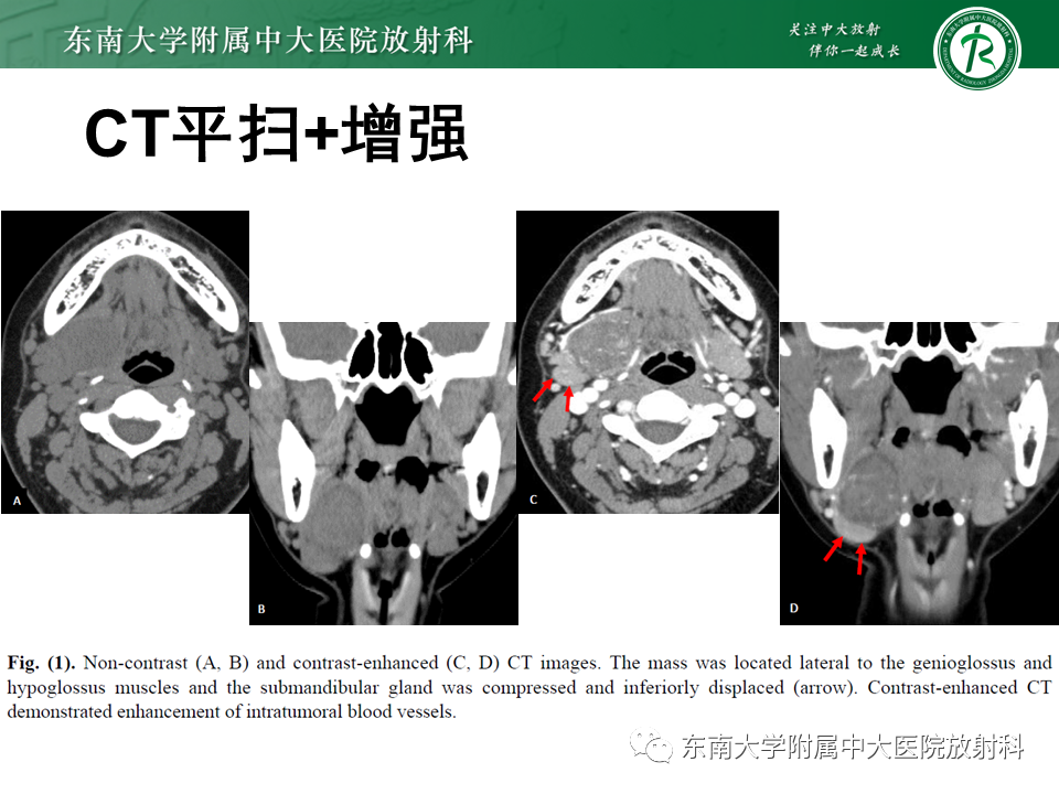 影像PPT - 【PPT】颌下间隙病变影像诊断-49 影像PPT - 【PPT】颌下间隙病变影像诊断-49