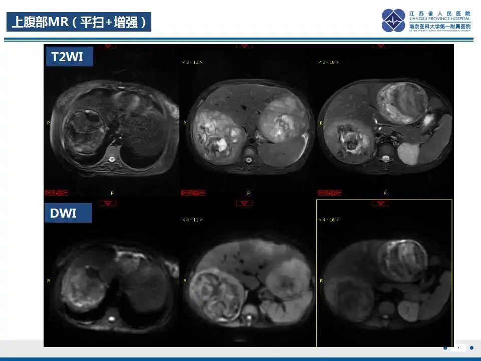 影像PPT - 【PPT】肝糖原累积症-5