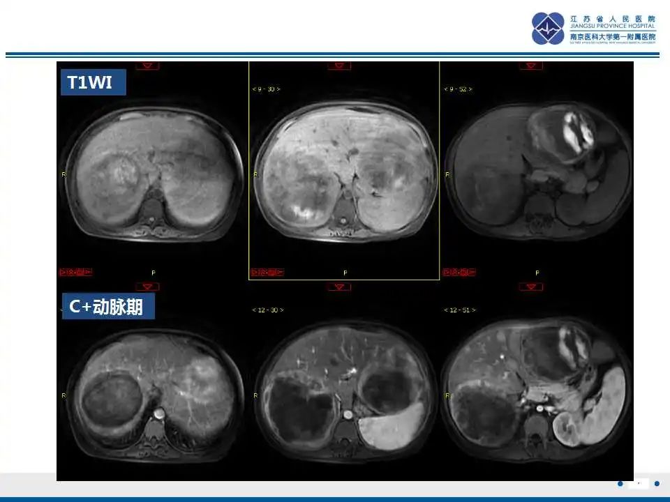 影像PPT - 【PPT】肝糖原累积症-7