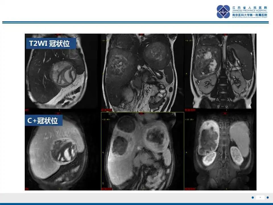 影像PPT - 【PPT】肝糖原累积症-9