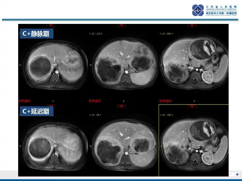 影像PPT - 【PPT】肝糖原累积症-8