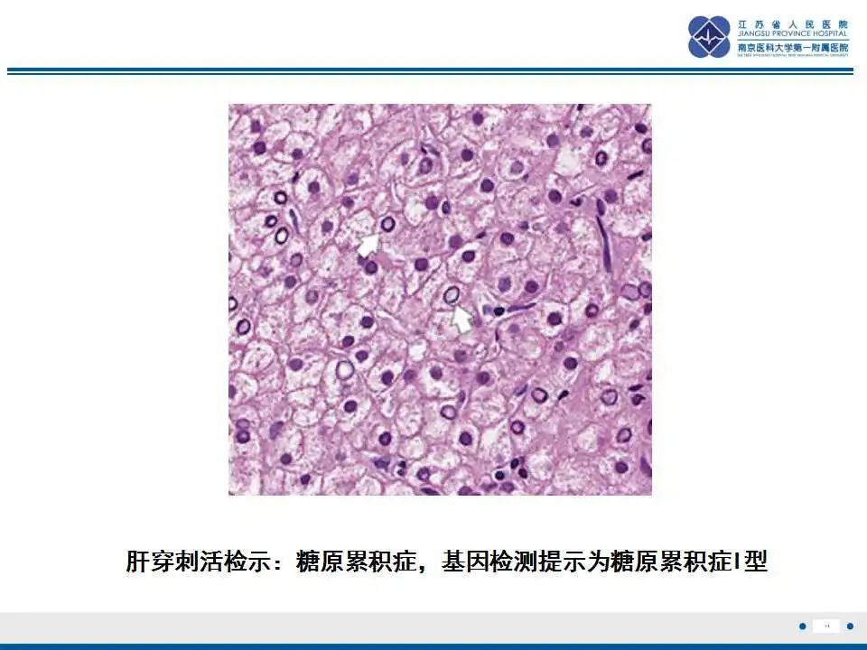 影像PPT - 【PPT】肝糖原累积症-14