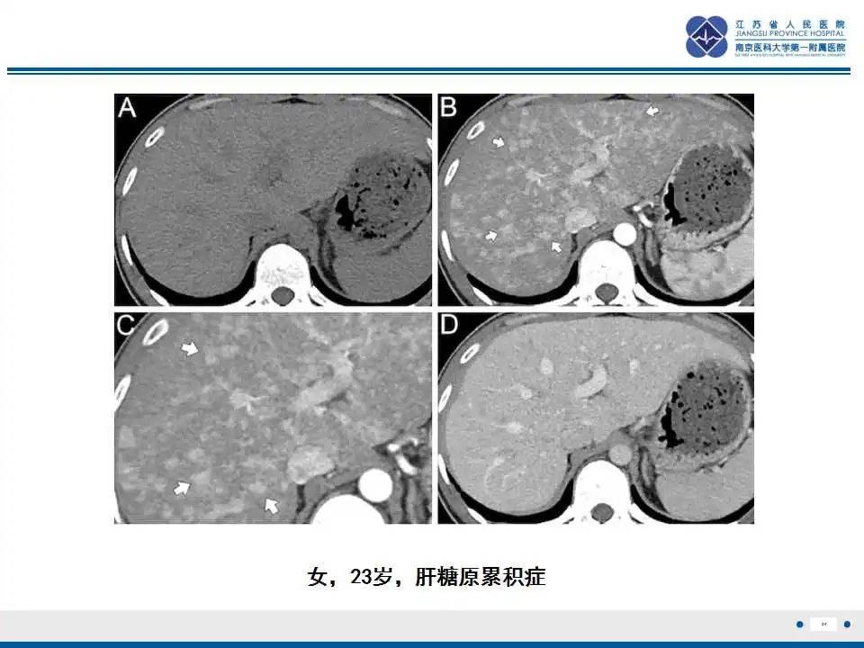 影像PPT - 【PPT】肝糖原累积症-20